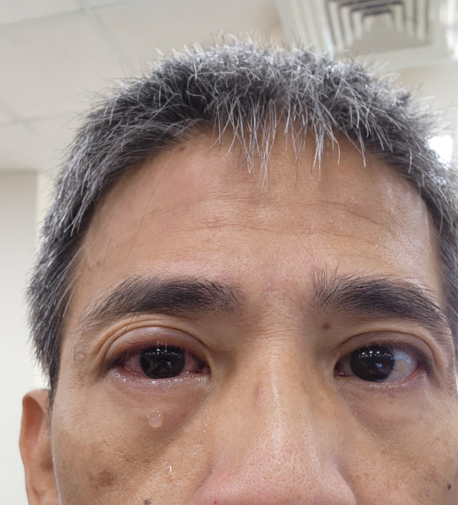 眼角膜被塑膠袋劃傷